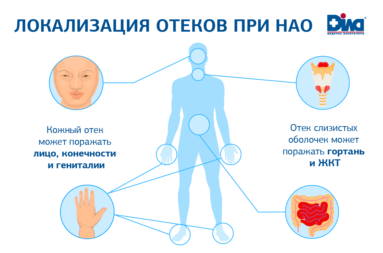 Наследственный ангионевротический отек