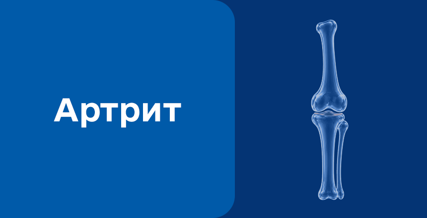 Фото - Артрит: причини, симптоми та сучасна діагностика