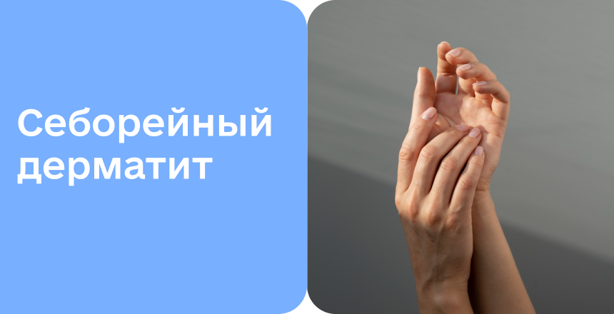Фото - Себорейный дерматит: от причин к лечению