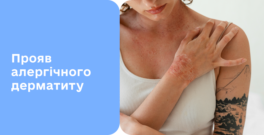 Як виглядає алергічний дерматит