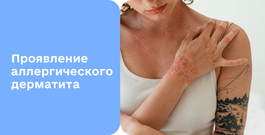Как выглядит аллергический дерматит